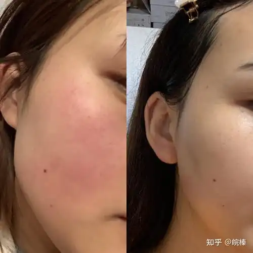 红血丝肌肤,角质层薄如何治疗?