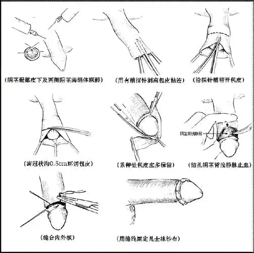 长春中西医结合医院男科李小燕主任谈小儿包皮手术:要有为人父母的