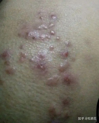 怎么更快的治好疥疮