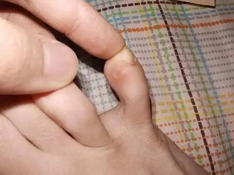 鸡眼长什么样子图片 鸡眼图片初期症状