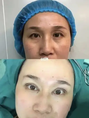 眼窝凹陷严重,术后即刻效果93_医美_美妆_医美整形