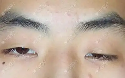 先对比眼睑下垂和眼皮下垂的区别再考虑做双眼皮还是提肌