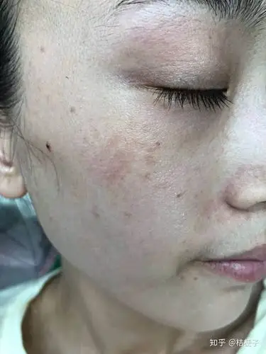 皮肤上有少许斑,怎么淡斑?