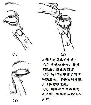 涂眼:用手指往下拔开你的下眼皮,把眼药膏/眼用凝胶挤进眼睛,然后用