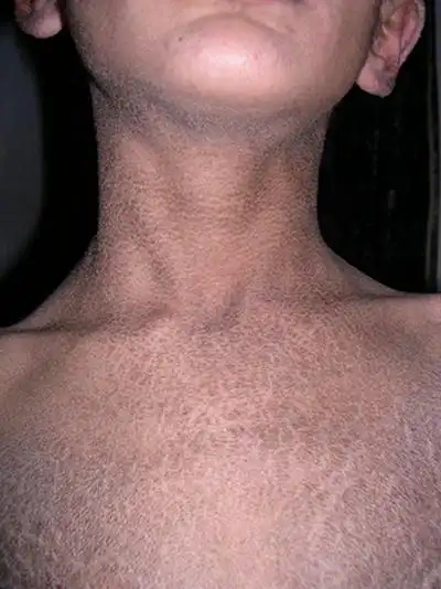 鱼鳞病初期图片 (68)