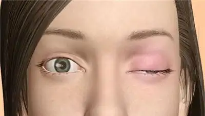 重症肌无力初期症状都有哪些