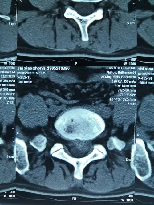 腰椎间盘ct平扫(l5-s1)