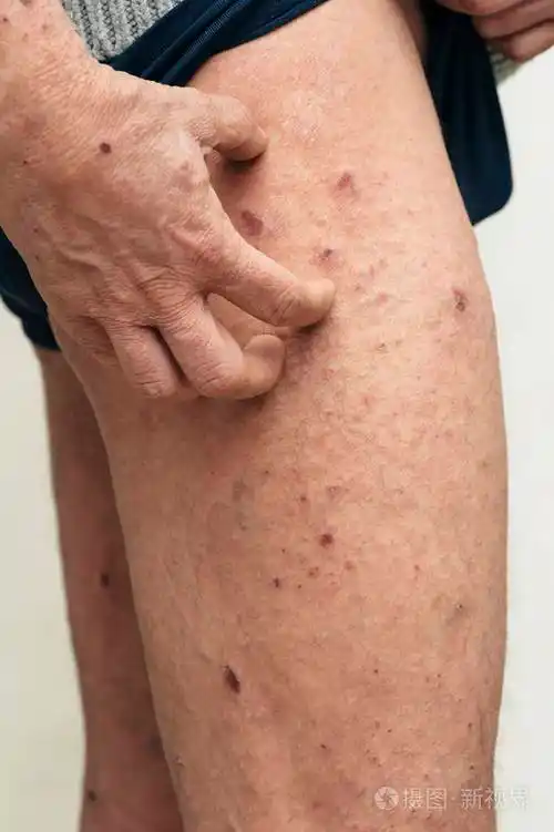 有皮肤瘙痒和干燥问题的人