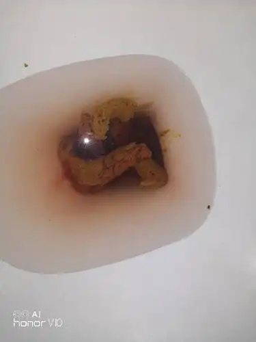 喝红酒后大便黑色是什么原因