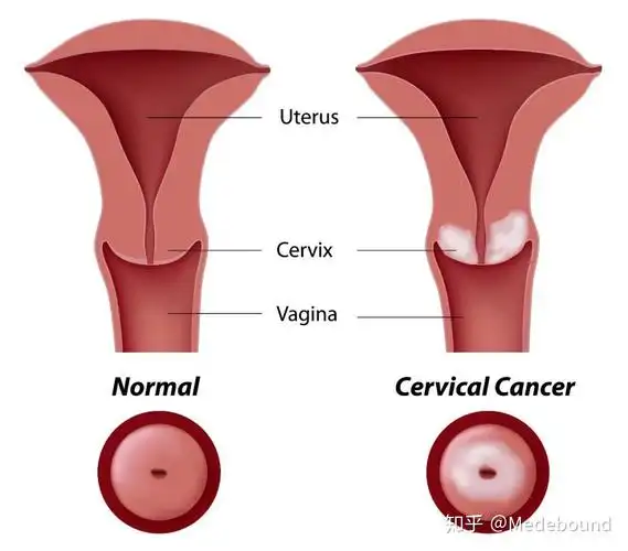 女性第二大癌症——宫颈癌(附美国科普视频)