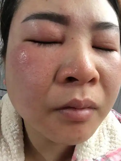 如何预防脸部过敏?