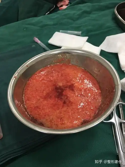 先来一波脂肪填充抽脂抽出来的脂肪以及纤维组织的照片吧:往前倒三年