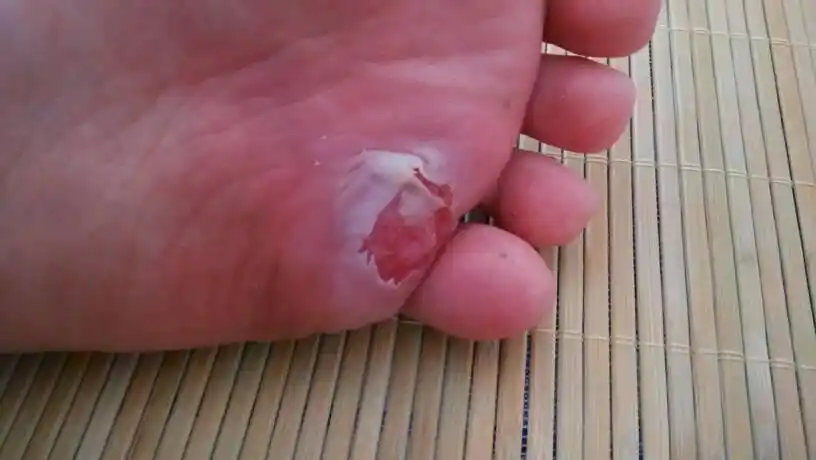 军训脚起泡了,怎么处理好的快,谢啦!