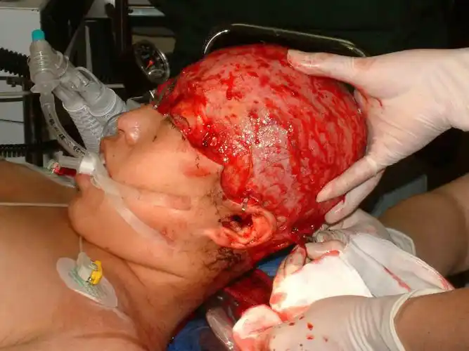 头皮撕脱伤可以再植_头皮撕脱伤_治疗方法_治疗方式 - 好大夫在线