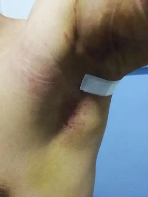 腋臭微创刮吸术——腋臭患者的福音