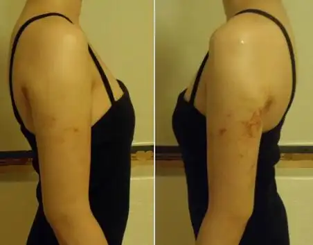 鼻部 胸部 眼眉 身体塑形 抗衰老 皮肤 其他 虽然现在还会看见淤青