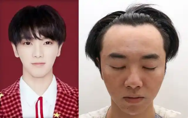 华晨宇植发照疑曝光爆料人称张碧晨插足自己还叫华晨宇老公