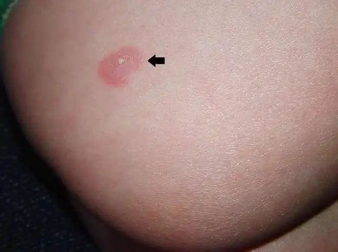 女性梅毒症状图片大全_有来医生