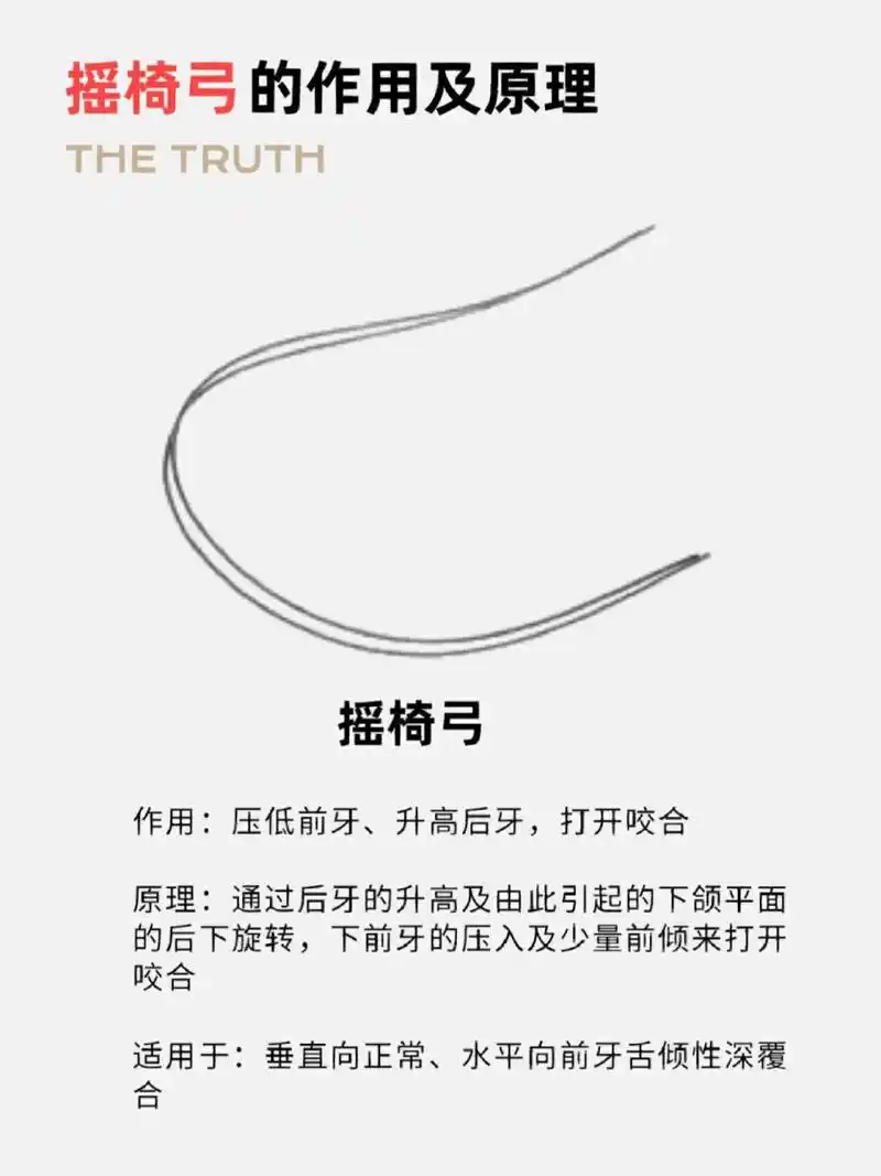 正畸 摇椅弓的作用及原理 作用 压低前牙,升高后牙,打开咬合 原理