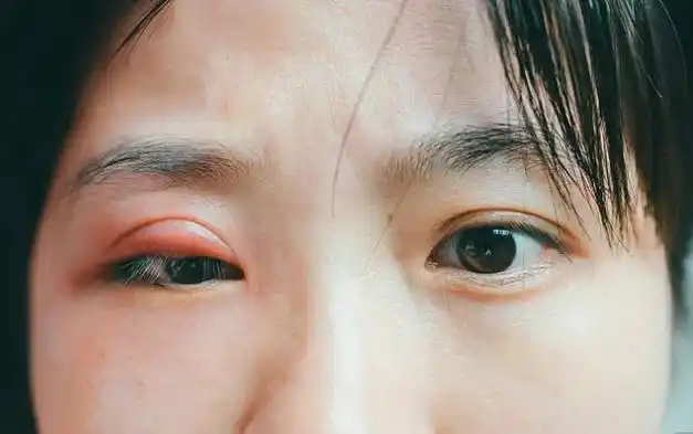 重症肌无力之眼肌型者,无痛之日,君亦能享之