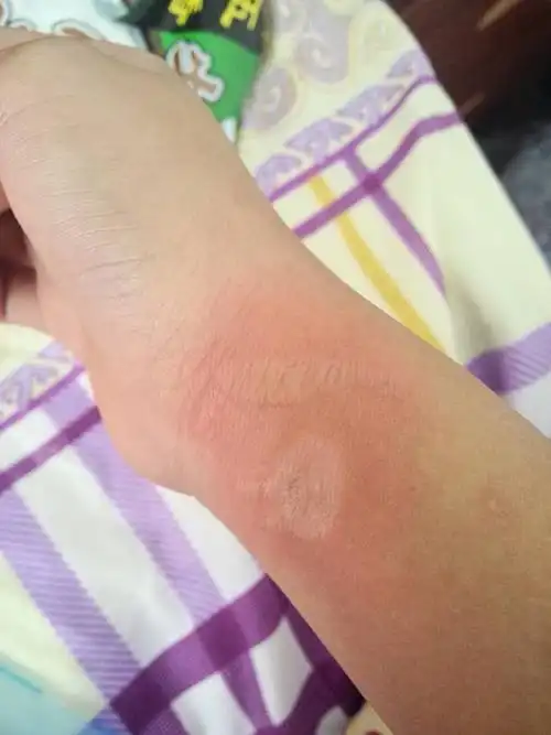 烫伤的大概20分钟前伤的怎么样,一直火辣辣的疼要不要去医院看看_百度