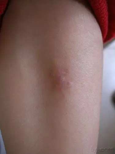 门诊病例9隆突性皮肤纤维肉瘤