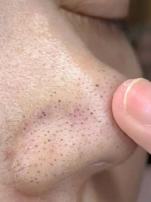 黑头不能挤,如何科学去黑头?