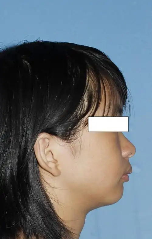 矫正为什么要拔牙