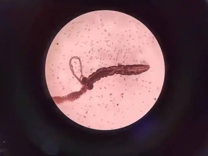 杭州9岁男孩总说痒,上厕所竟发现很多白色的……_蛲虫_虫卵_寄生虫