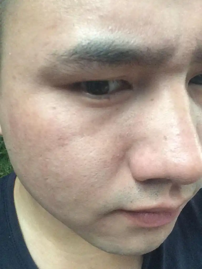 热心网友  2015-12-21   展开全部 有起皮的情况吗  追答 皮肤粗糙