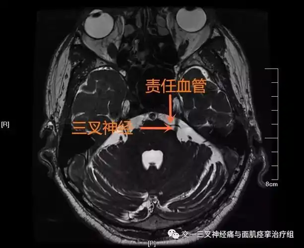 三叉神经痛,面肌痉挛手术前的主要影像学检查