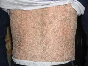 蛇身鱼鳞病的诊治