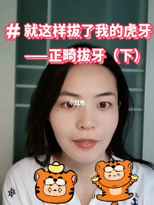 正畸牙拔除下虎牙也拔啦