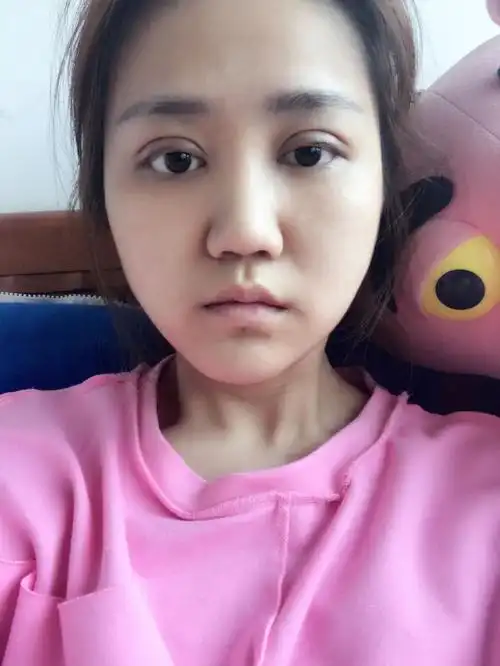 做了全切双眼皮 内眼角 上眼睑下垂,今天第十天了,肉条颜色好深,感觉