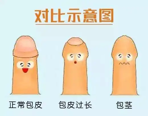 宝宝割包皮别盲目跟风,先得清楚这几点