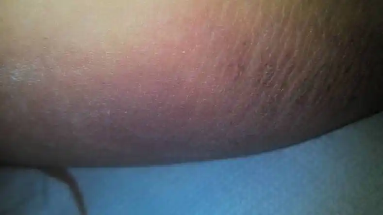 大腿根部两侧都有一大块红的,而且一出汗就会痛的走路都困难