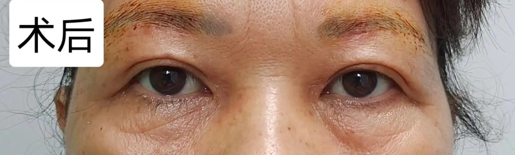 中老年上眼睑皮肤松弛矫正 - 好大夫在线