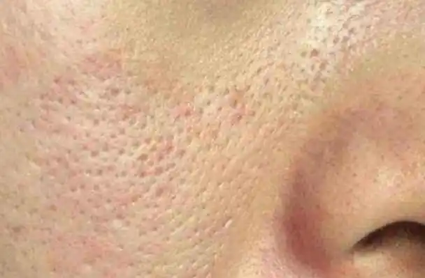 面部毛孔粗大怎么办怎么收缩毛孔