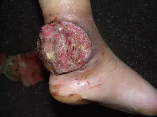 左足皮肤进行性溃烂