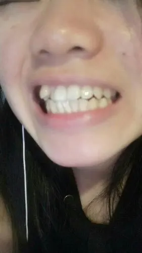 这虎牙能不能拔