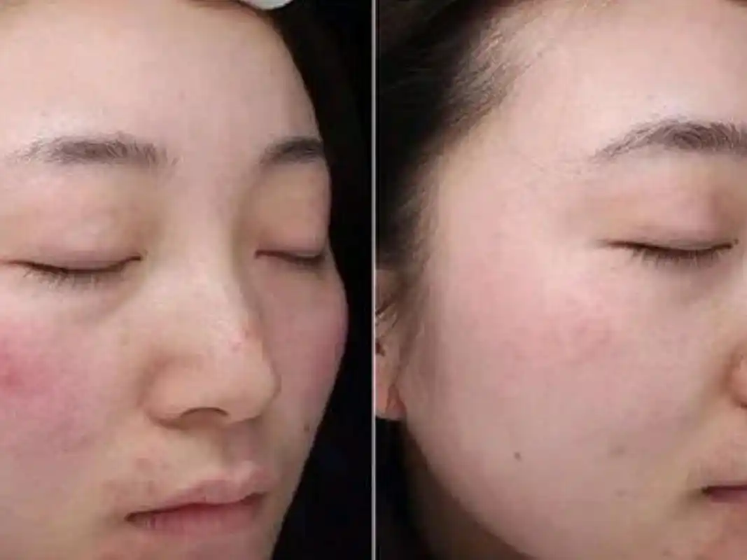 果酸换肤效果图,4大优点,令你焕然一新!