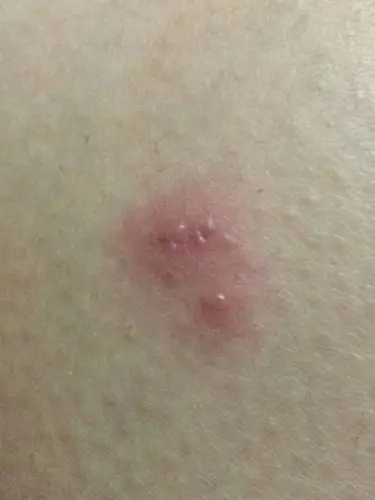 大腿内侧长了几块红色,很痒,附图片,请问是什么