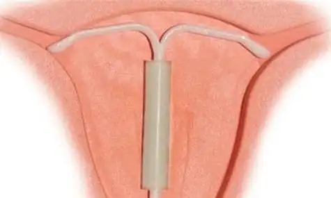 女性摘环的最佳时间是什么时候(女人摘环月经后的最佳时期是什么时候)