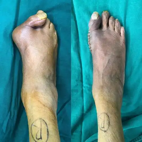 术前风险感比较大,手术顺利.