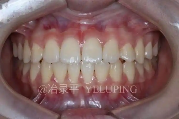 上唇系带过短的手术时机