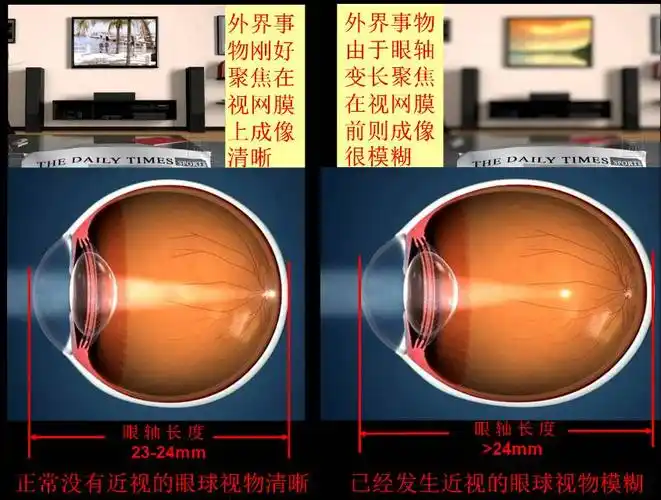 专家就眼球的结构和眼球因近视产生的变化进行了深入地讲解.