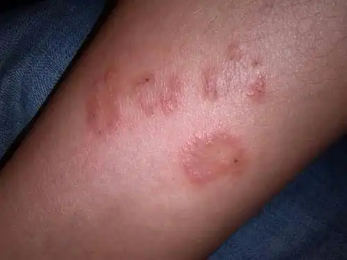 2013-08-12 09:16提问者采纳 是胧癣. 追问 ?