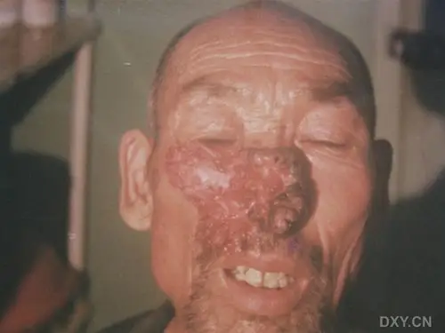 【讨论】看图识病····面部溃烂5年