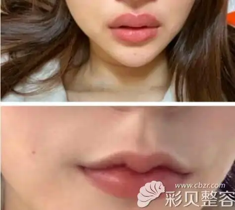 厚唇做手术微笑唇恢复前后对比照看过的人都说比做m唇好看