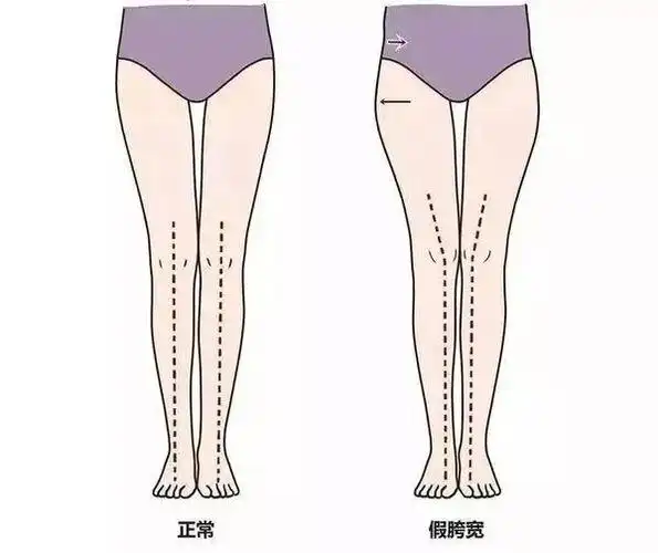 我们再来讲讲腿型,腿型一般分为正常腿型,x型腿,o型腿和xo型腿,正常腿